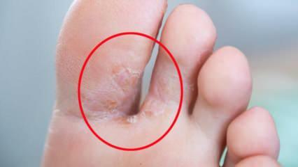 Mis on jalgade seen? Millised on jala seenhaiguse sümptomid? Kas sportlase jalga saab ravida?