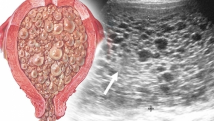 Mis on mooli rasedus (viinamarja rasedus), millised on selle sümptomid? Kuidas mõista mooli rasedust?