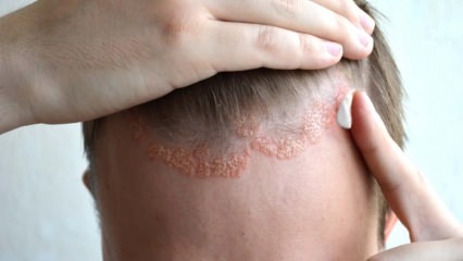 Millised on seborroilise dermatiidi sümptomid ja kellele see ilmneb? Toiduained, mis haiguse käivitavad