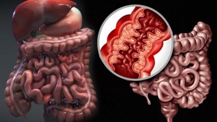 Mis on Crohni tõbi? Millised on Crohni tõve sümptomid? Kas Crohni saab ravida?