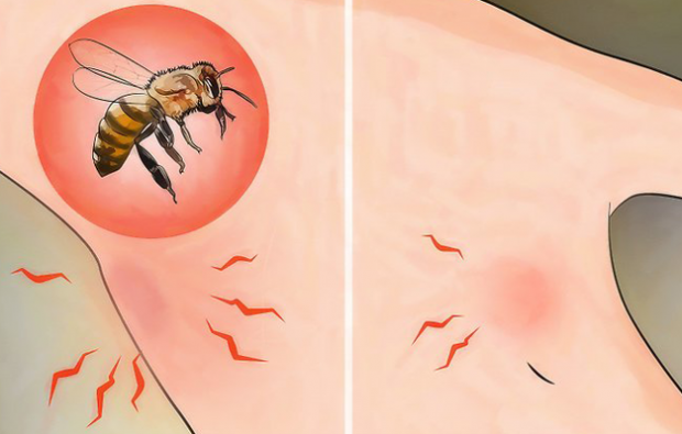 Mis on mesilaste allergia ja millised on selle sümptomid? Looduslikud meetodid, mis sobivad hästi mesilaste nõelamiseks