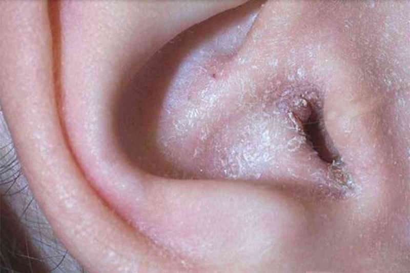 Mis põhjustab kõrva taga koorumist ja kuidas see möödub? Lõplik lahendus kõrva taga olevale ekseemile ...