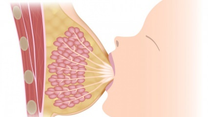 Mis on mastiit (rinnapõletik)? Mastiidi sümptomid ja ravi imetamise ajal