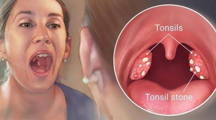 tonsilliiti nimetatakse mandlite turseks