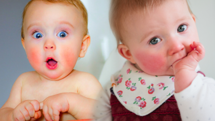 Tähelepanu punaste põskedega imikutel! Põse põsasündroom ja selle sümptomid