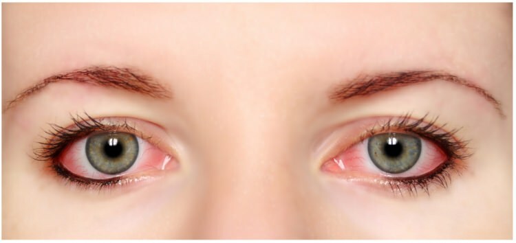 Kas ripsmetušš ja silmapliiats on allergiline silmades?