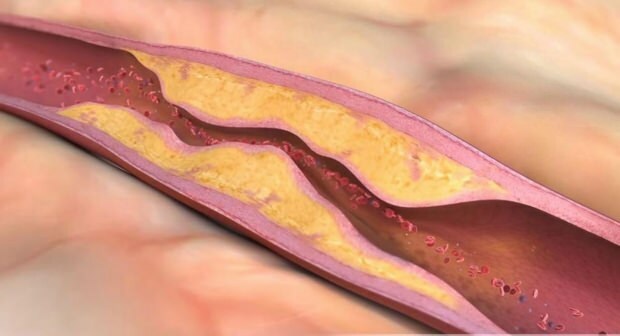 Mis põhjustab ateroskleroosi? Mitu tüüpi vaskulaarset oklusiooni on olemas?