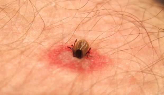 Mis putukahammustus on kuidas? Putukate hammustuste sümptomid! Looduslik meetod sääsehammustuste jaoks