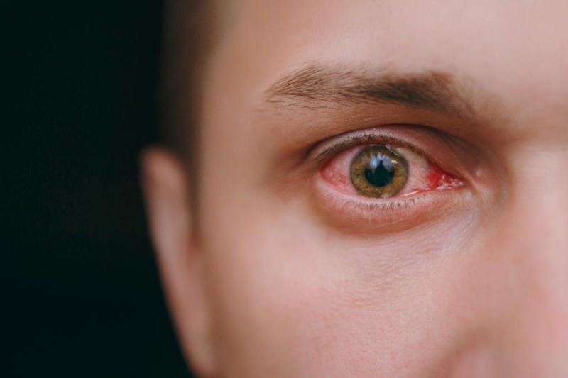 silma kastmine, verejooks ja sügelused koroonaviiruse sümptomid