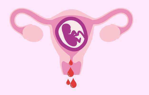 verejooksu põhjused raseduse ajal