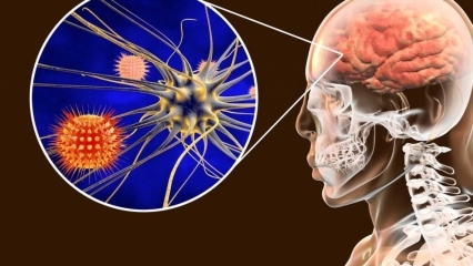Mis on meningiit ja millised on selle sümptomid? Kas meningiiti saab ravida?