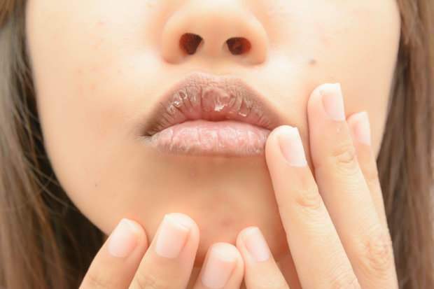 aneemia põhjustab huulte kuivamist
