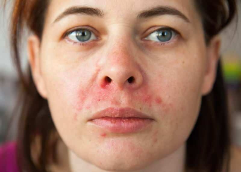 Miks akne ilmub huule ümber? Kuidas ravitakse perioodilist dermatiiti?