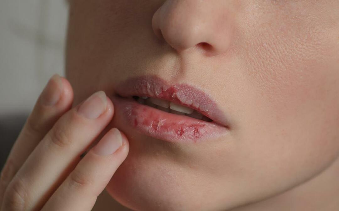 Mis põhjustab tumedaid huuli? Kuidas ravitakse huulte tumenemist või verevalumeid?
