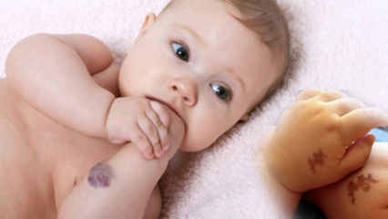 Põhjustab imikute sünnimärki, kas see on püsiv? Millised on sünnimärgid? Ravi Saracoglu juurest