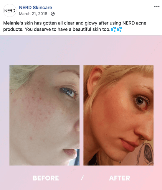 Näide sellest, kuidas Nerd Skincare kasutas enne ja pärast pilti sotsiaalmeedia jaoks pildipostituse loomiseks, mis juhib nende toodete ostmist.