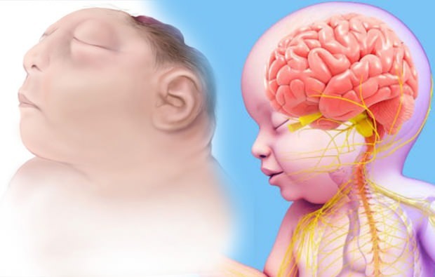 Kas Anencephaly beebi elab? Anentsefaalne diagnoos