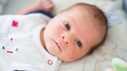 Kuidas pimples lapse näol lähevad? Akne (Milia) kuivatusmeetodid