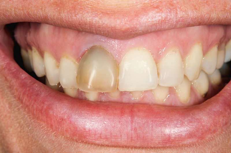 hammaste tumenemine võib mõnikord keskenduda ühele hambale