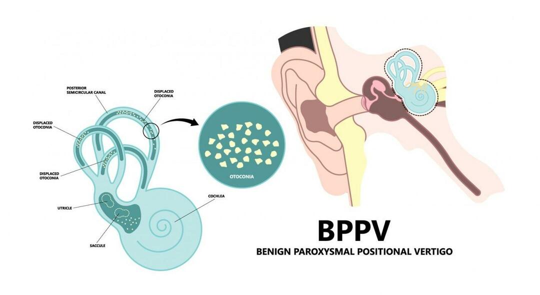 Miks pea käib lamades ringi? Mis on healoomulise paroksüsmaalse positsioonilise peapöörituse jaoks hea? Kuidas BPPV-st lahti saada