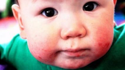 Kuidas suuhaavandid imikutel mööduvad? Intraoraalsete haavade sümptomid ja kodused ravimeetodid imikutel