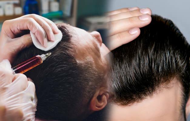 Kas juuste siirdamine on lubatud? Mis on juuksed proteesimine?