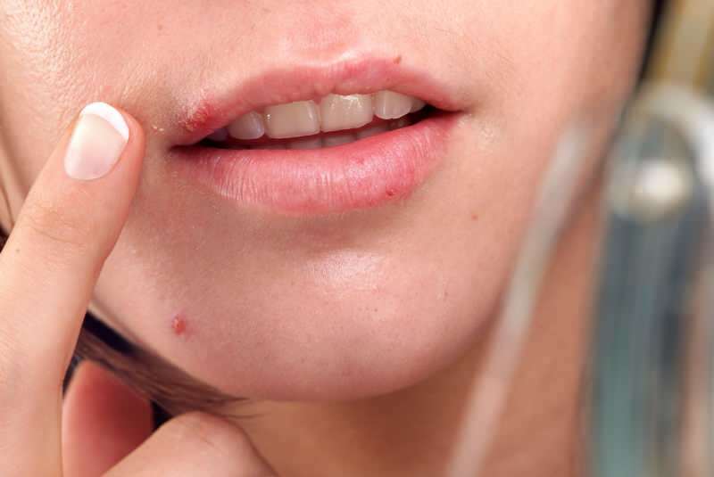 herpes tuleb tavaliselt välja huule servas.