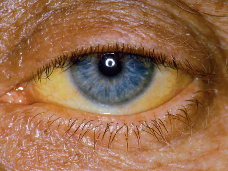 kõrgus bilirubiini tasemel põhjustab silmade ja naha kollast värvi