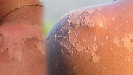 Mis on naha koorimiseks kasulik ja kuidas naha koorimine? Kodune vahend naha koorimiseks