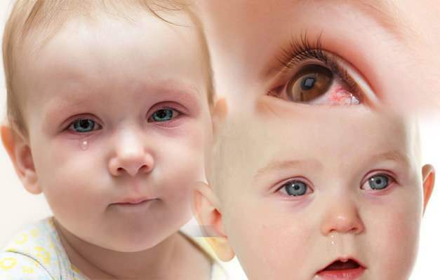 Miks saavad imikute silmad verd? Kuidas möödub vastsündinud lapsel silma verejooks?