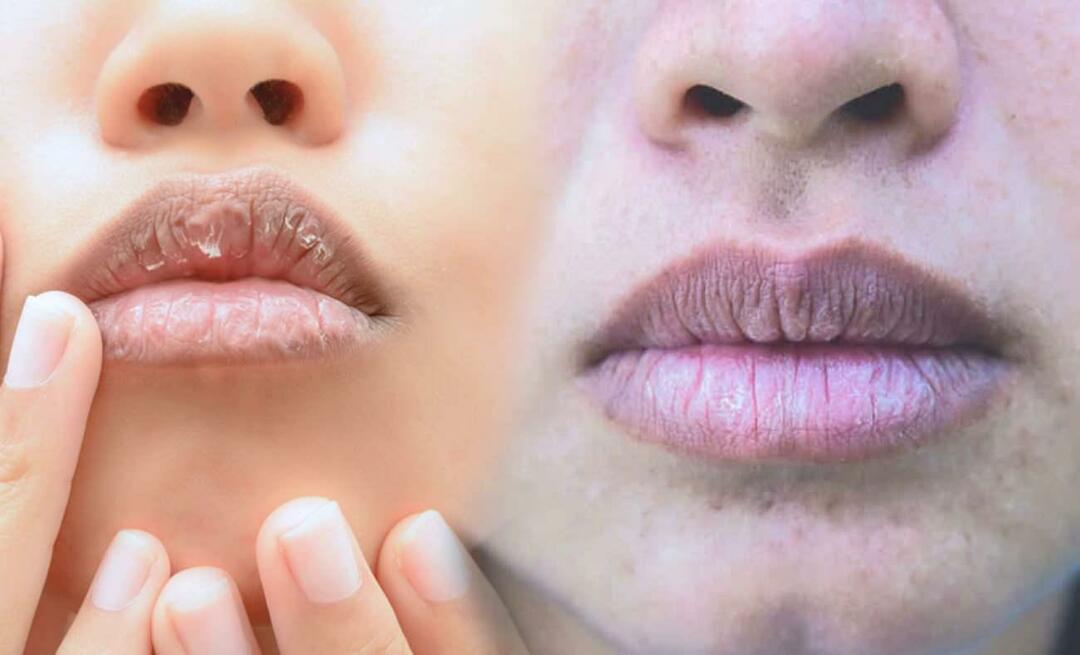 Mis põhjustab tumedaid huuli? Kuidas ravitakse huulte tumenemist või verevalumeid?