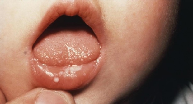 Kuidas valutab suu imikutel