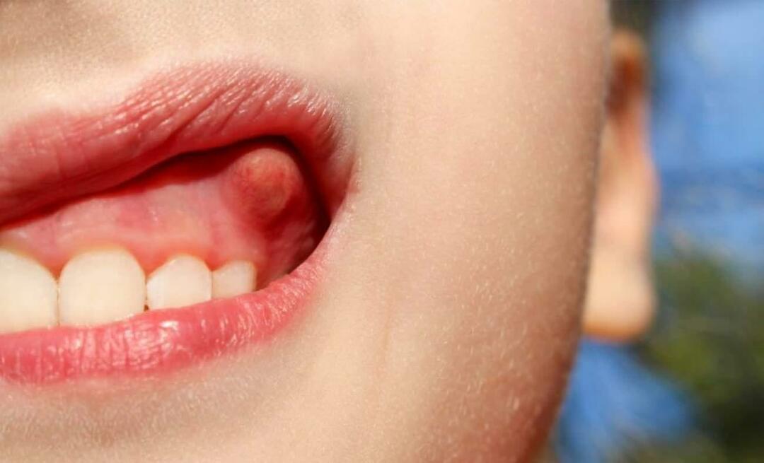 Miks tekib hamba abstsess ja millised on selle sümptomid? Hambaabstsess, kuidas seda ravitakse?
