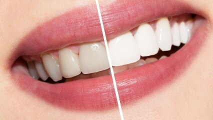 Millised on soovitused valgete hammaste jaoks? Hammaste valgendamine ravib kodus loomulikult ...