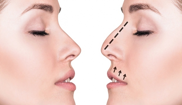 Kuidas tehakse ninaoperatsiooni? Millistel juhtudel tehakse rinoplastiline operatsioon?