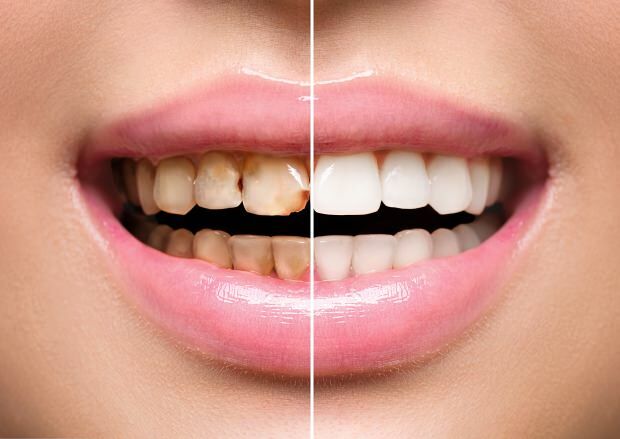 Ebatervisliku toitumise tagajärjel tekivad nii hammaste värvimuutused kui ka hammaste väljalangemine