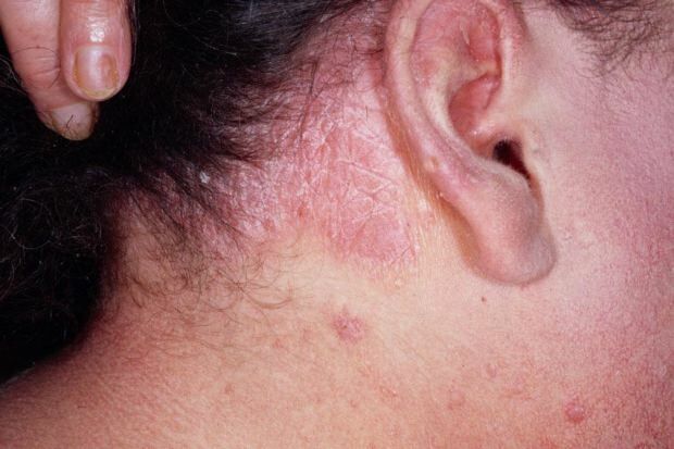 Millised on seborroilise dermatiidi sümptomid ja kellele see ilmneb? Toiduained, mis haiguse käivitavad