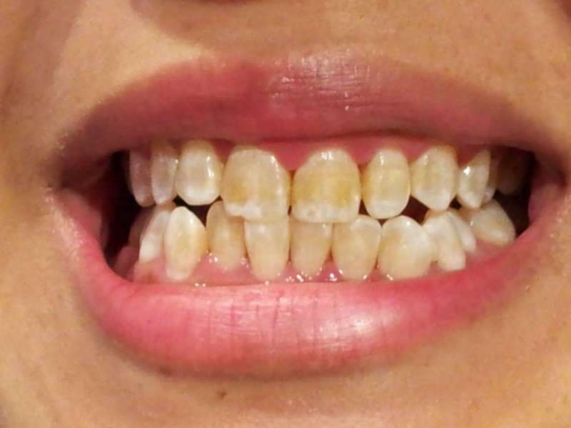 inimese hammaste pilt, kelle hambad hakkavad tumenema