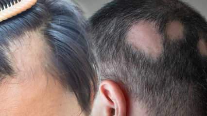 Mis on rõngas (Alopecia areata)? Mis on rõngaste sümptomid? Tõhusad lahendused rõngaste jaoks