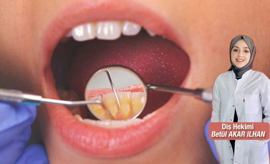 Mida tuleks teha, et hambakivi ei tekiks? Mis kasu on hambaravist?