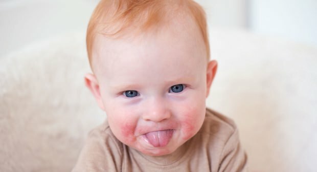 Tähelepanu punaste põskedega imikutel! Põse põsasündroom ja selle sümptomid