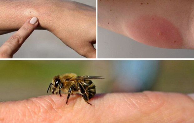 mesilaste allergia sümptomid