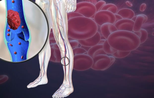 vereringe vähenemine jalgade veenides põhjustab valu